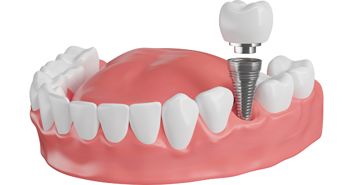 痛みはあるの？インプラント手術の流れと注意点